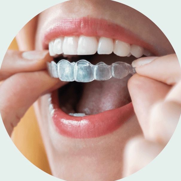 Zahnkorrektur, Aligner, Zahnschiene, Dr.Smile